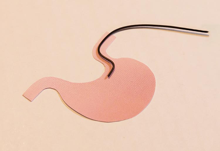 胃镜检查（上消化道内窥镜）的介绍